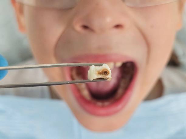 Best Emergency Dental Care for Abscessed Tooth in Plantsville, CT